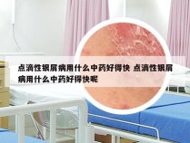 点滴性银屑病用什么中药好得快 点滴性银屑病用什么中药好得快呢