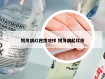 银屑病红疙瘩啥样 银屑病起红疹