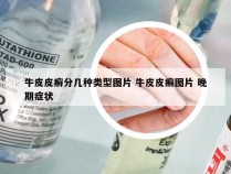 牛皮皮癣分几种类型图片 牛皮皮癣图片 晚期症状