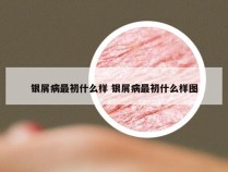 银屑病最初什么样 银屑病最初什么样图