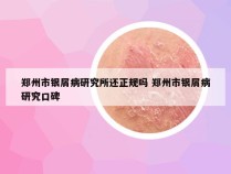 郑州市银屑病研究所还正规吗 郑州市银屑病研究口碑