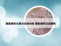 银屑病可以用冷冻技术吗 银屑病可以冰敷吗