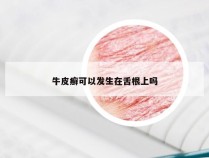 牛皮癣可以发生在舌根上吗