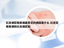 红皮病型银屑病最常见的病因是什么 红皮型银屑病和红皮病区别