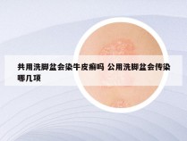 共用洗脚盆会染牛皮癣吗 公用洗脚盆会传染哪几项