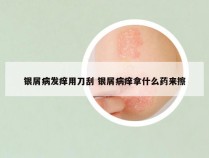 银屑病发痒用刀刮 银屑病痒拿什么药来擦