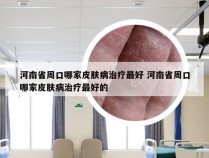 河南省周口哪家皮肤病治疗最好 河南省周口哪家皮肤病治疗最好的