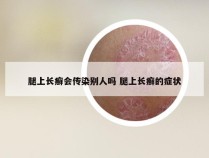 腿上长癣会传染别人吗 腿上长癣的症状