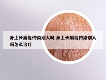 身上长癣能传染别人吗 身上长癣能传染别人吗怎么治疗