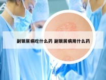 副银屑病吃什么药 副银屑病用什么药