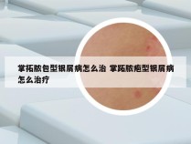 掌拓脓包型银屑病怎么治 掌跖脓疱型银屑病怎么治疗