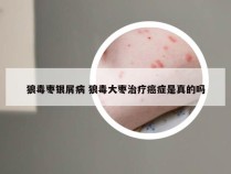 狼毒枣银屑病 狼毒大枣治疗癌症是真的吗