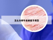 怎么分辨牛皮癣属于类型