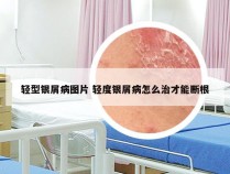 轻型银屑病图片 轻度银屑病怎么治才能断根