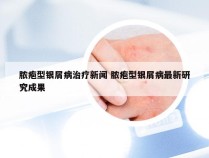 脓疱型银屑病治疗新闻 脓疱型银屑病最新研究成果