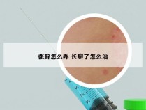 张藓怎么办 长癣了怎么治