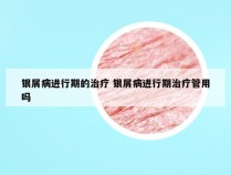 银屑病进行期的治疗 银屑病进行期治疗管用吗