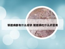 银翘病都有什么症状 银翘病吃什么药管用