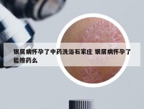 银屑病怀孕了中药洗浴石家庄 银屑病怀孕了能擦药么