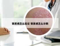 银屑病怎么验证 银屑病怎么诊断