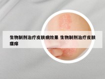 生物制剂治疗皮肤病效果 生物制剂治疗皮肤瘙痒