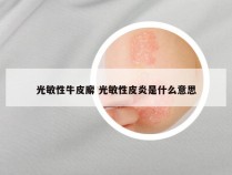 光敏性牛皮廨 光敏性皮炎是什么意思