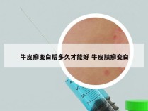 牛皮癣变白后多久才能好 牛皮肤癣变白