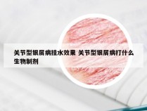 关节型银屑病挂水效果 关节型银屑病打什么生物制剂