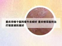 重庆市哪个医院看牛皮癣好 重庆哪家医院治疗银屑病效果好