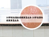 18岁的女孩头皮癣多怎么办 18岁女孩头皮屑多怎么办