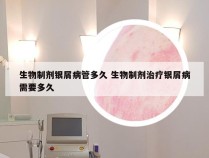 生物制剂银屑病管多久 生物制剂治疗银屑病需要多久