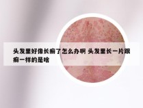 头发里好像长癣了怎么办啊 头发里长一片跟癣一样的是啥