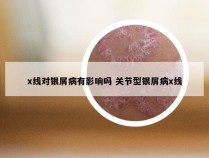 x线对银屑病有影响吗 关节型银屑病x线