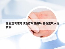 藿香正气液可以治疗牛皮癣吗 藿香正气水治皮癣