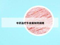 中药治疗牛皮癣如何调理