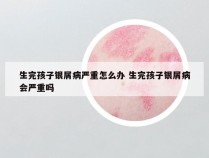 生完孩子银屑病严重怎么办 生完孩子银屑病会严重吗