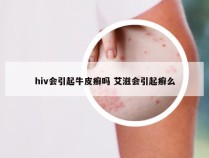 hiv会引起牛皮癣吗 艾滋会引起癣么