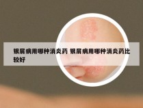 银屑病用哪种消炎药 银屑病用哪种消炎药比较好