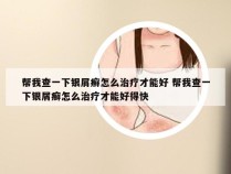 帮我查一下银屑癣怎么治疗才能好 帮我查一下银屑癣怎么治疗才能好得快