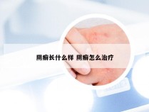 阴癣长什么样 阴癣怎么治疗