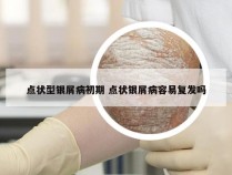 点状型银屑病初期 点状银屑病容易复发吗