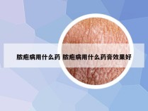 脓疱病用什么药 脓疱病用什么药膏效果好