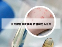 治疗脓包型皮肤癣 脓包癣怎么治疗