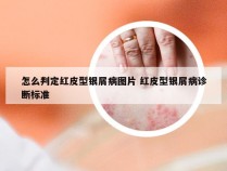 怎么判定红皮型银屑病图片 红皮型银屑病诊断标准