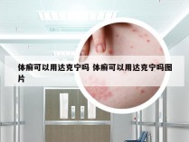 体癣可以用达克宁吗 体癣可以用达克宁吗图片