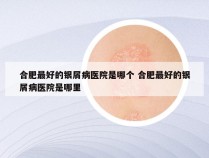 合肥最好的银屑病医院是哪个 合肥最好的银屑病医院是哪里