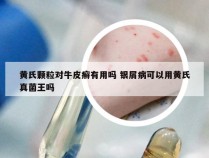 黄氏颗粒对牛皮癣有用吗 银屑病可以用黄氏真菌王吗