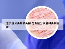 怎么区分头屑和头癣 怎么区分头屑和头癣图片