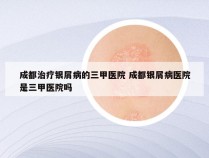 成都治疗银屑病的三甲医院 成都银屑病医院是三甲医院吗