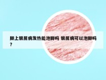 脚上银屑病发热能泡脚吗 银屑病可以泡脚吗?